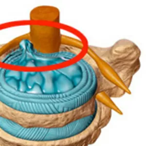 Лечение межпозвоночной грыжи без операции